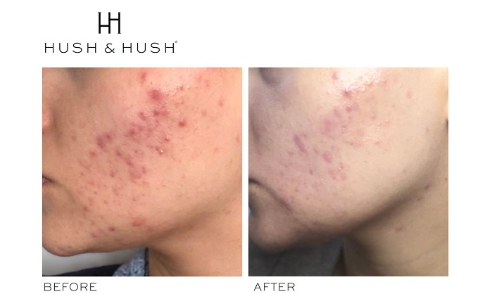 Viên uống trị mụn Hush & Hush Skincapsule Clear+